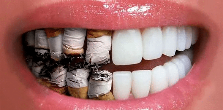 is smoking bad for your teeth